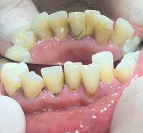 Before Teeth Cleaning