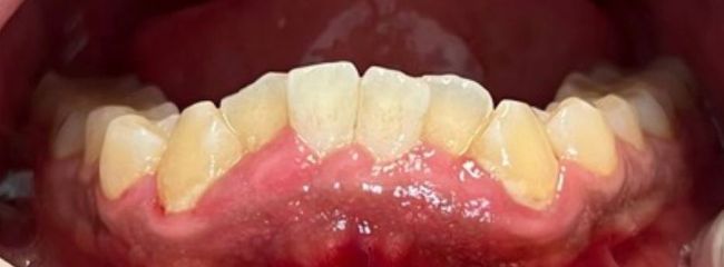 Before Full Mouth Rehabilitation