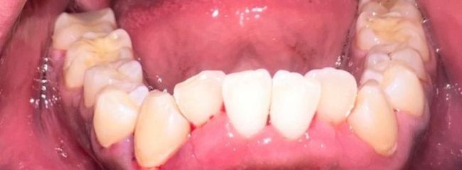 After Full Mouth Rehabilitation