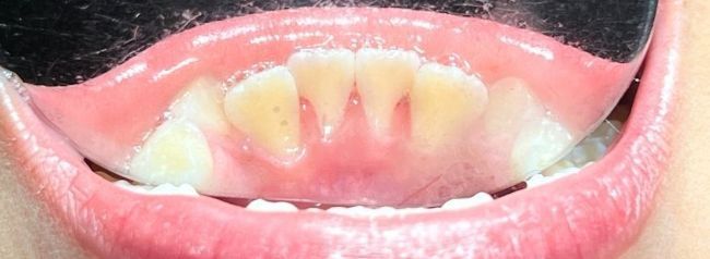 After Teeth Cleaning