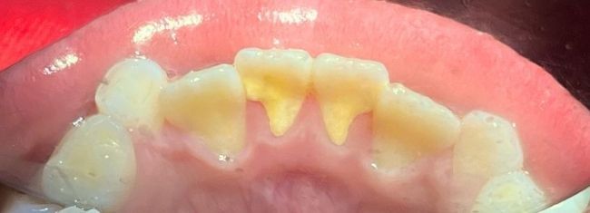 Before Teeth Cleaning