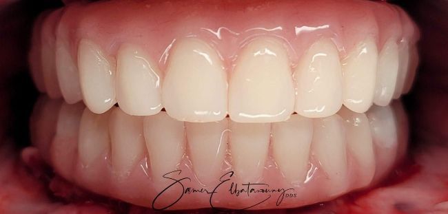 After Dental Veneers