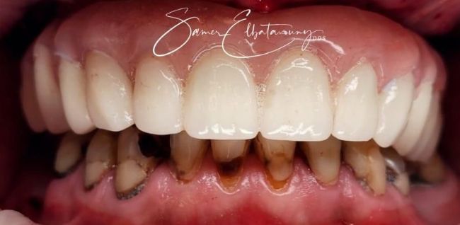 After Full Mouth Rehabilitation