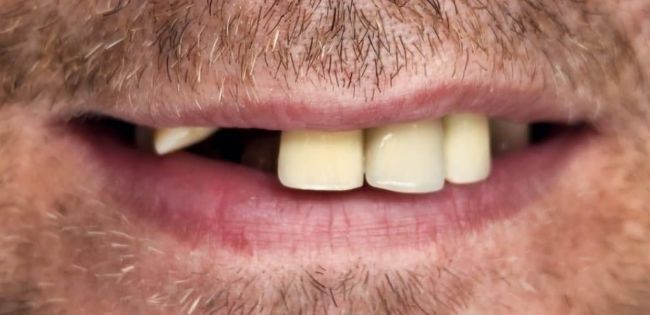 Before Dental Veneers