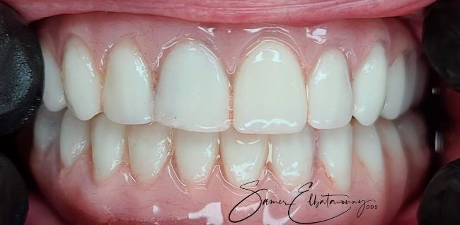 After Gum Contouring