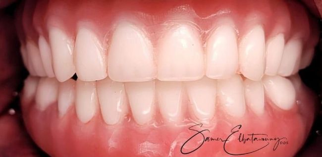 After Full Mouth Rehabilitation