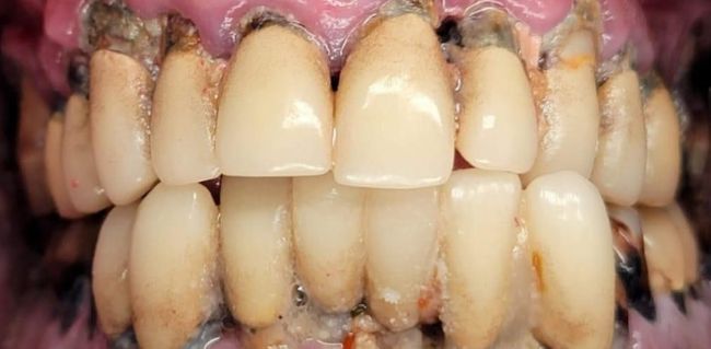 Before Full Mouth Rehabilitation