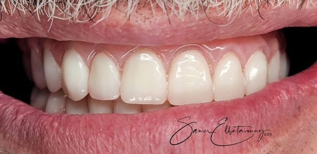 After Gum Contouring