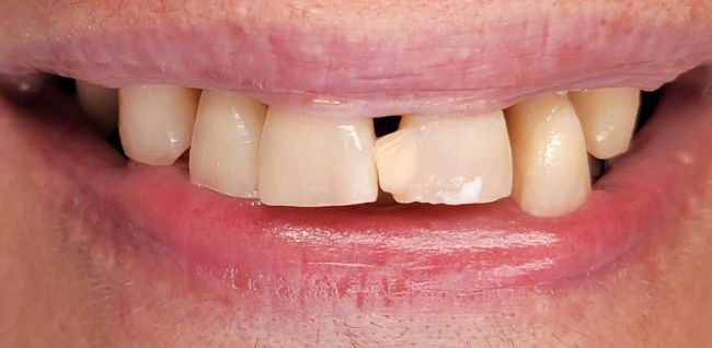 Before Composite Bonding