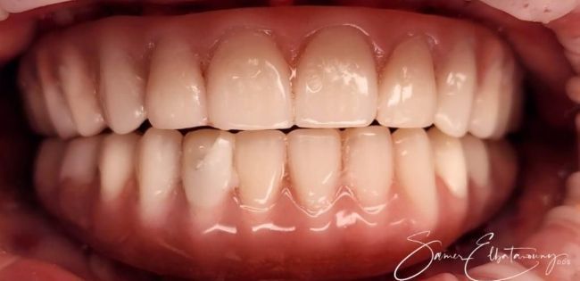 After Full Mouth Rehabilitation