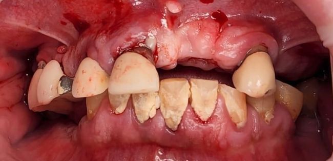 Before Full Mouth Rehabilitation