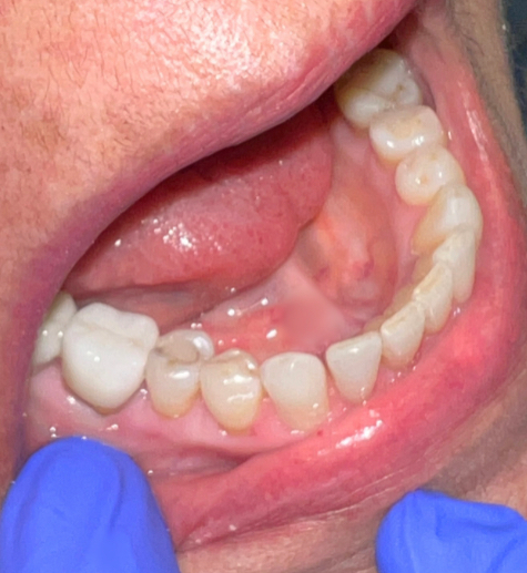 After Dental Implant