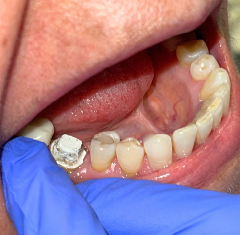 Before Dental Implant