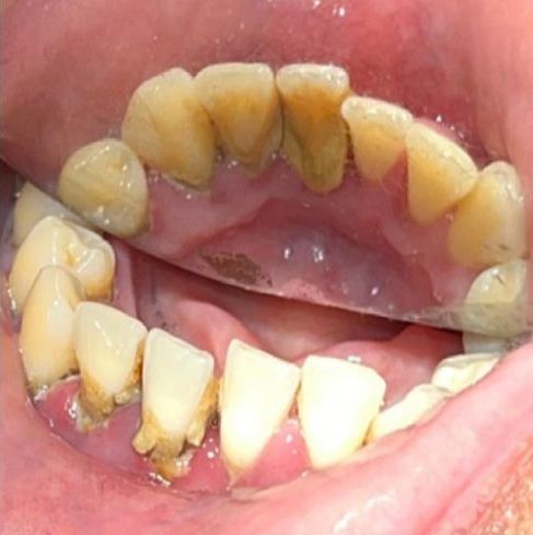 Before Teeth Cleaning