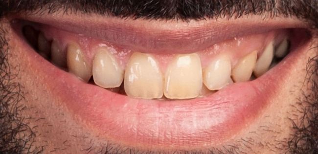Before Teeth Whitening