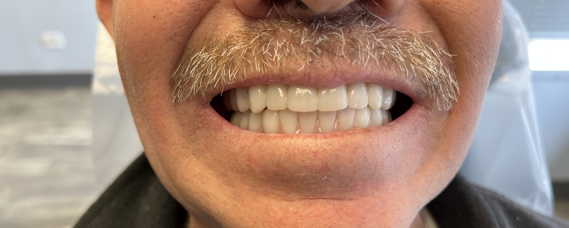 After Full Mouth Rehabilitation