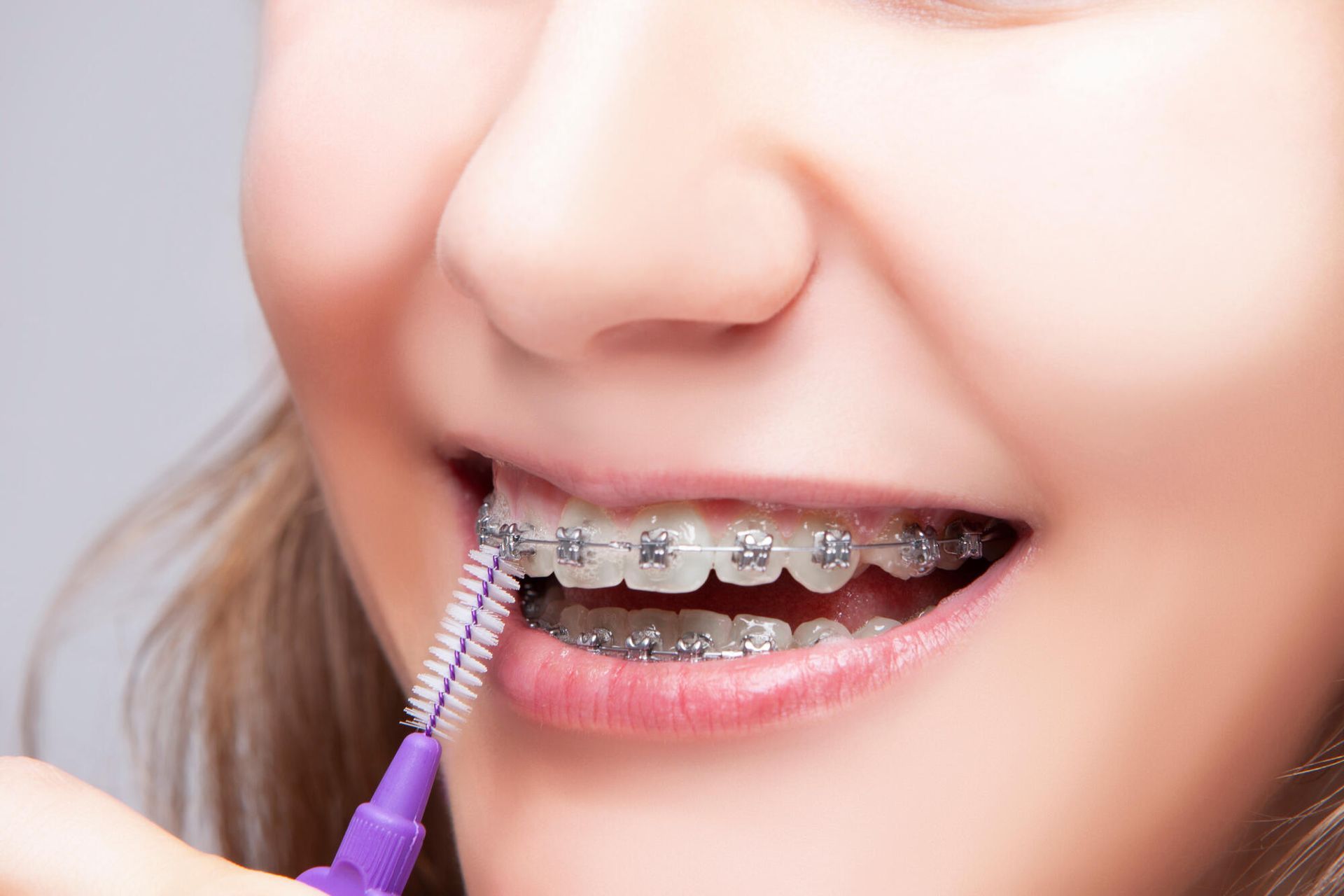 A woman with braces is brushing her teeth with an interdental brush.
