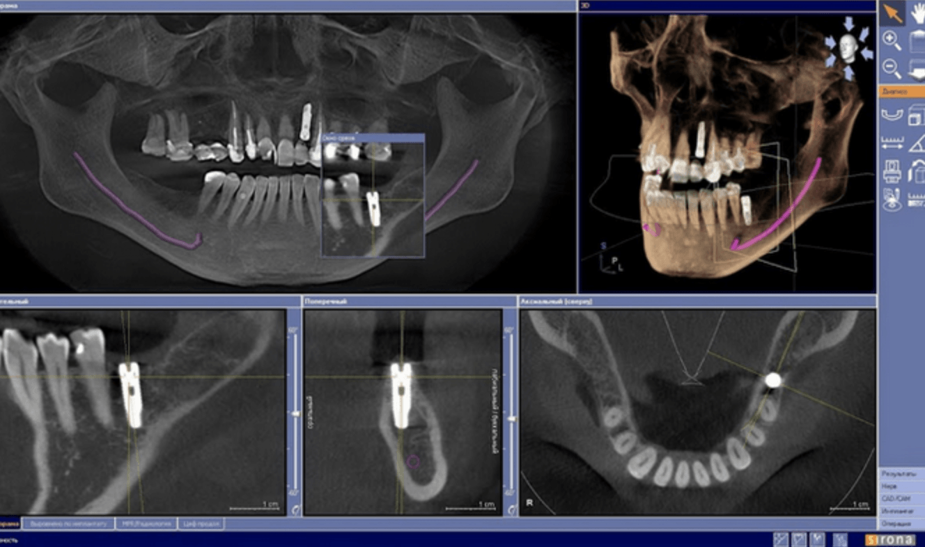 Konusinio pluošto kompiuterinė tomografija (CBCT arba kitaip vadinama 3D)