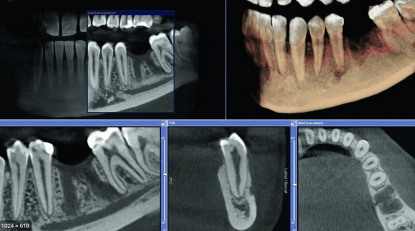 Konusinio pluošto kompiuterinė tomografija (CBCT arba kitaip vadinama 3D)