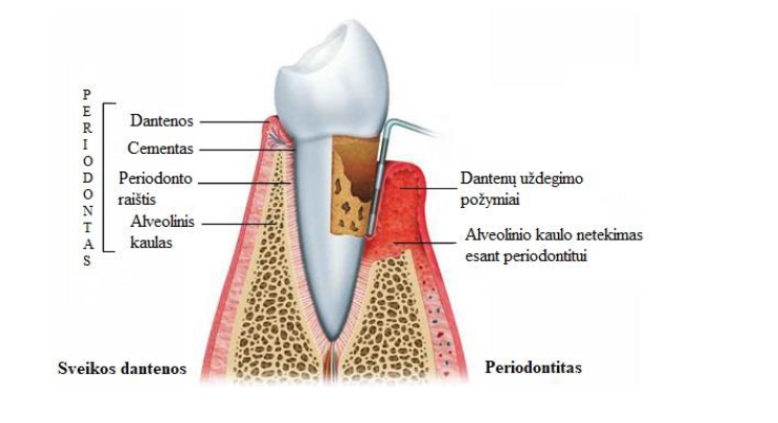 periodontas