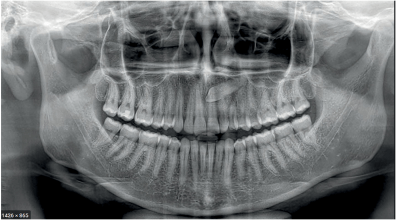 Žandikaulių skaitmeninės rentgeno nuotraukos (Ortopantomogramos)