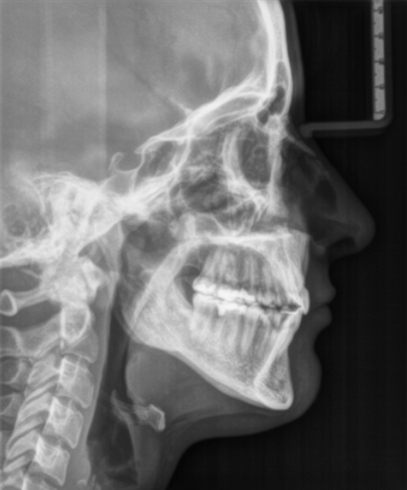 Šoninės galvos skaitmeninės rentgeno nuotraukos (Cefalogramos)