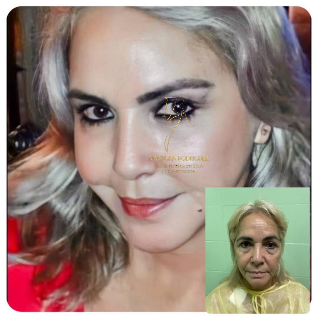 Una foto de antes y después del rostro de una mujer.