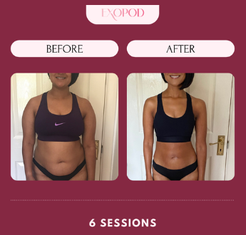 Before and after photos of a woman in a sports bra and underwear, showing weight loss after six Exopod sessions. She smiles in the 