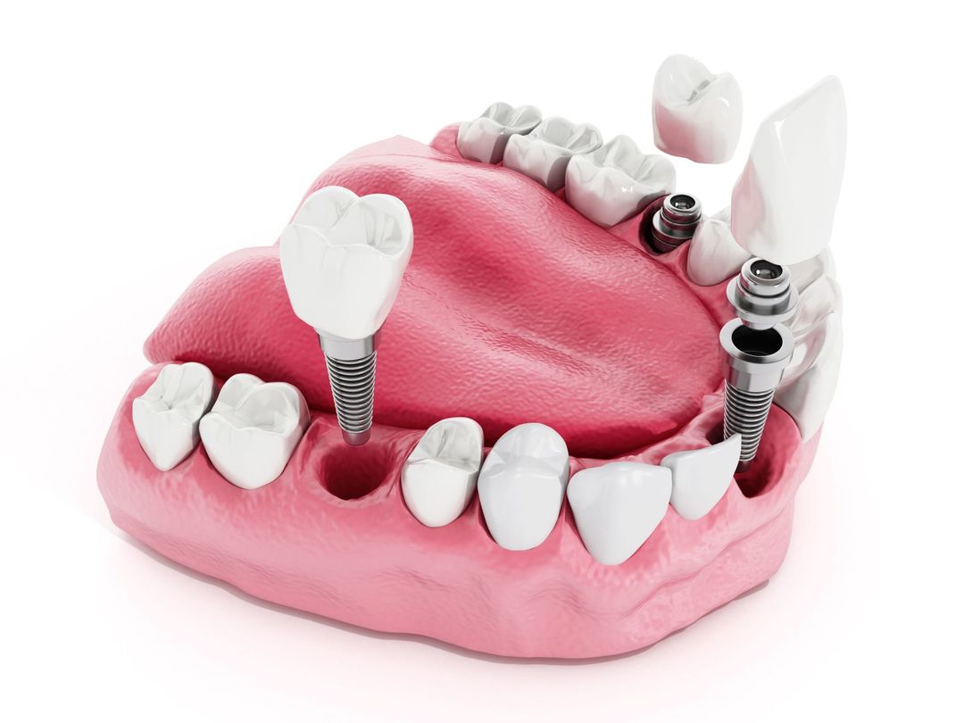 impianti dentali chirurgia generativa