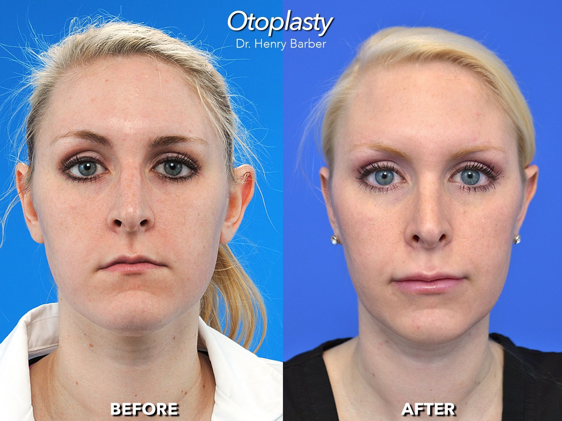 client at barber facial plastic surgery before and after otoplasty - mobile al henry barber 