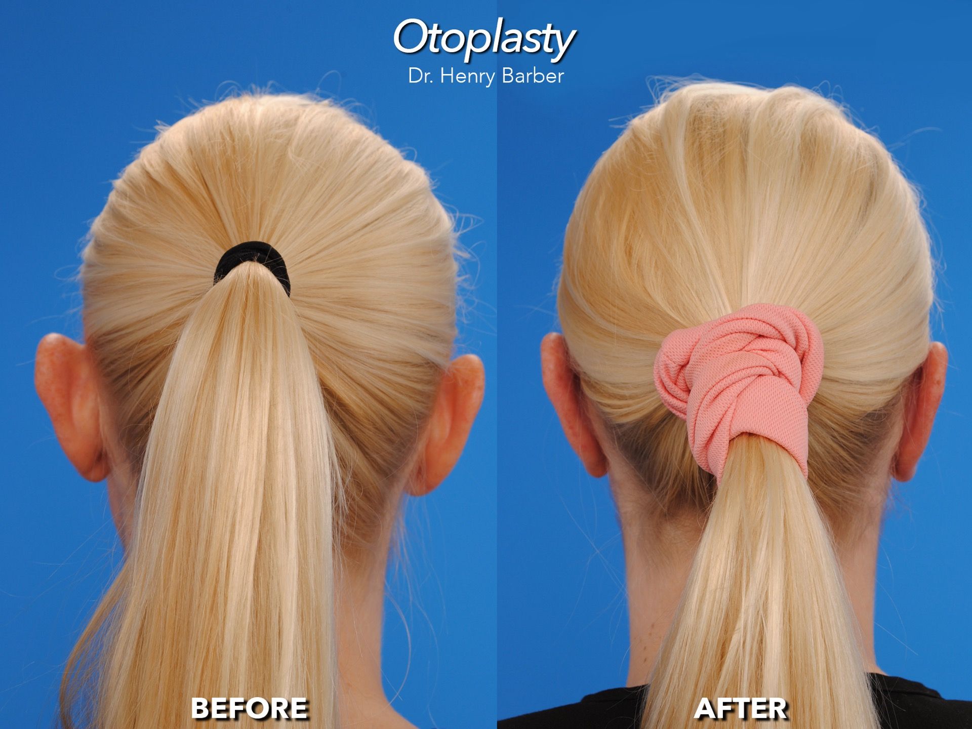 client at barber facial plastic surgery before and after otoplasty - mobile al henry barber 