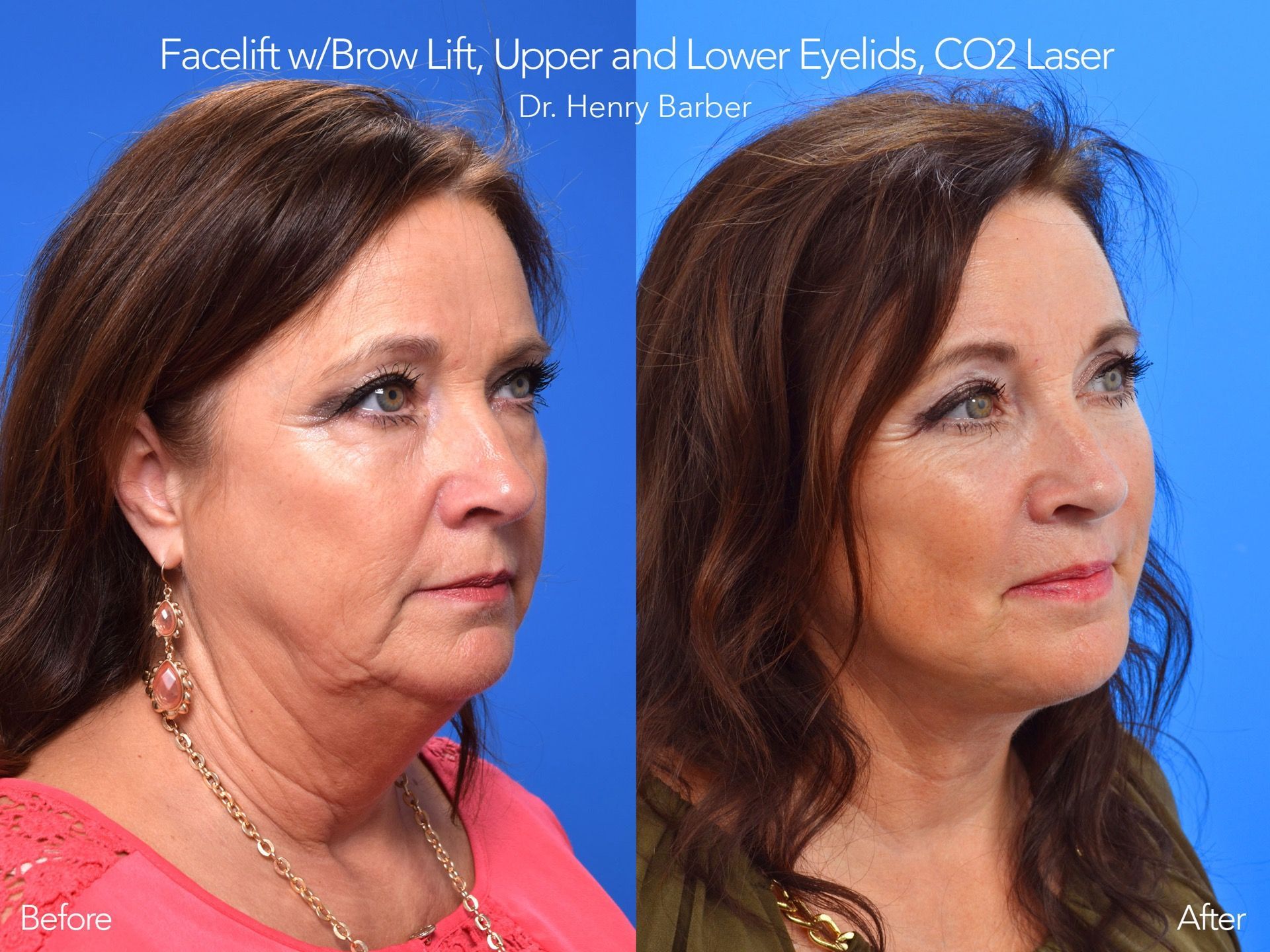 client at barber facial plastic surgery before and after facelift with brow lift- mobile al henry barber