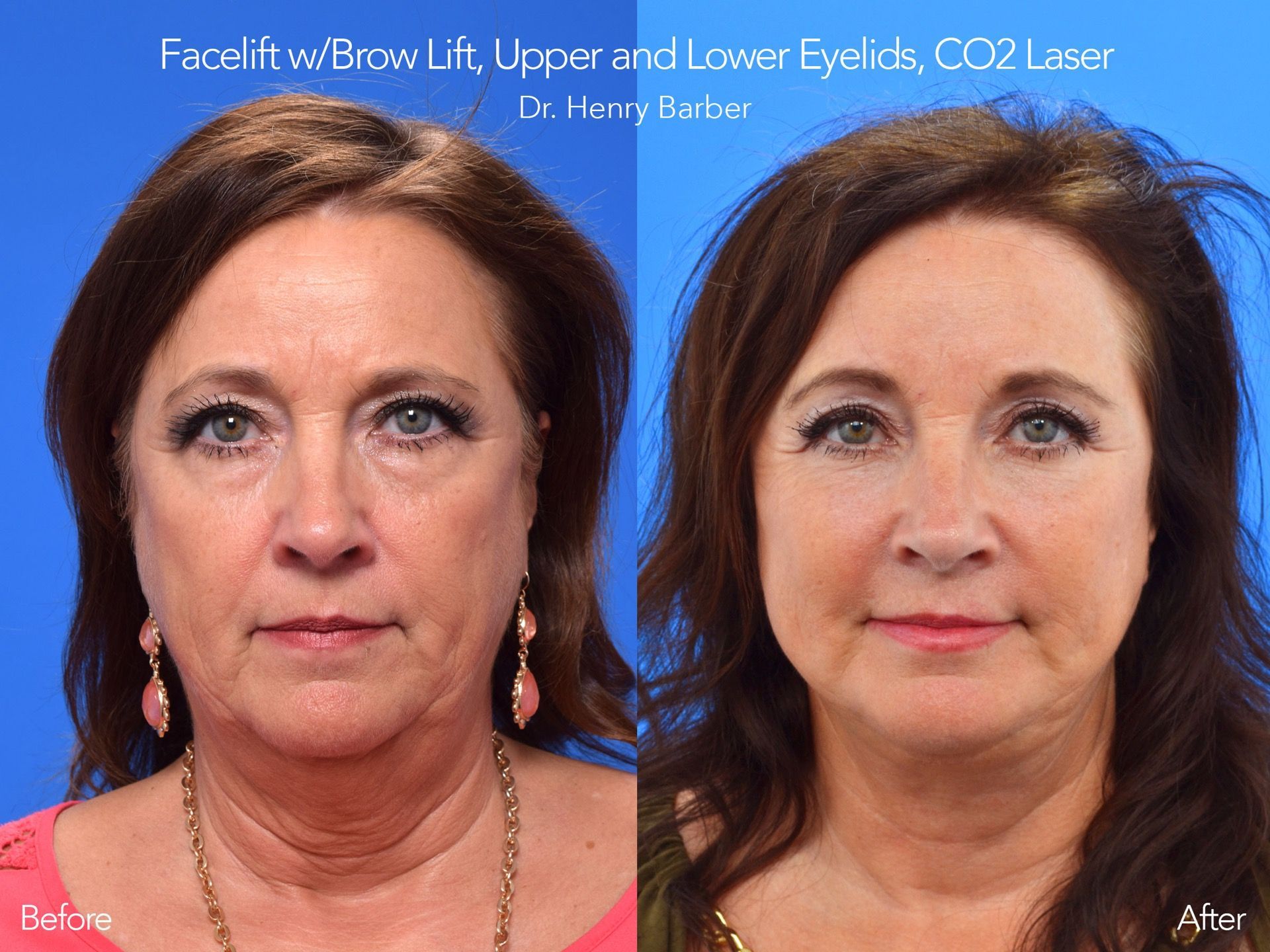 client at barber facial plastic surgery before and after facelift with brow lift- mobile al henry barber