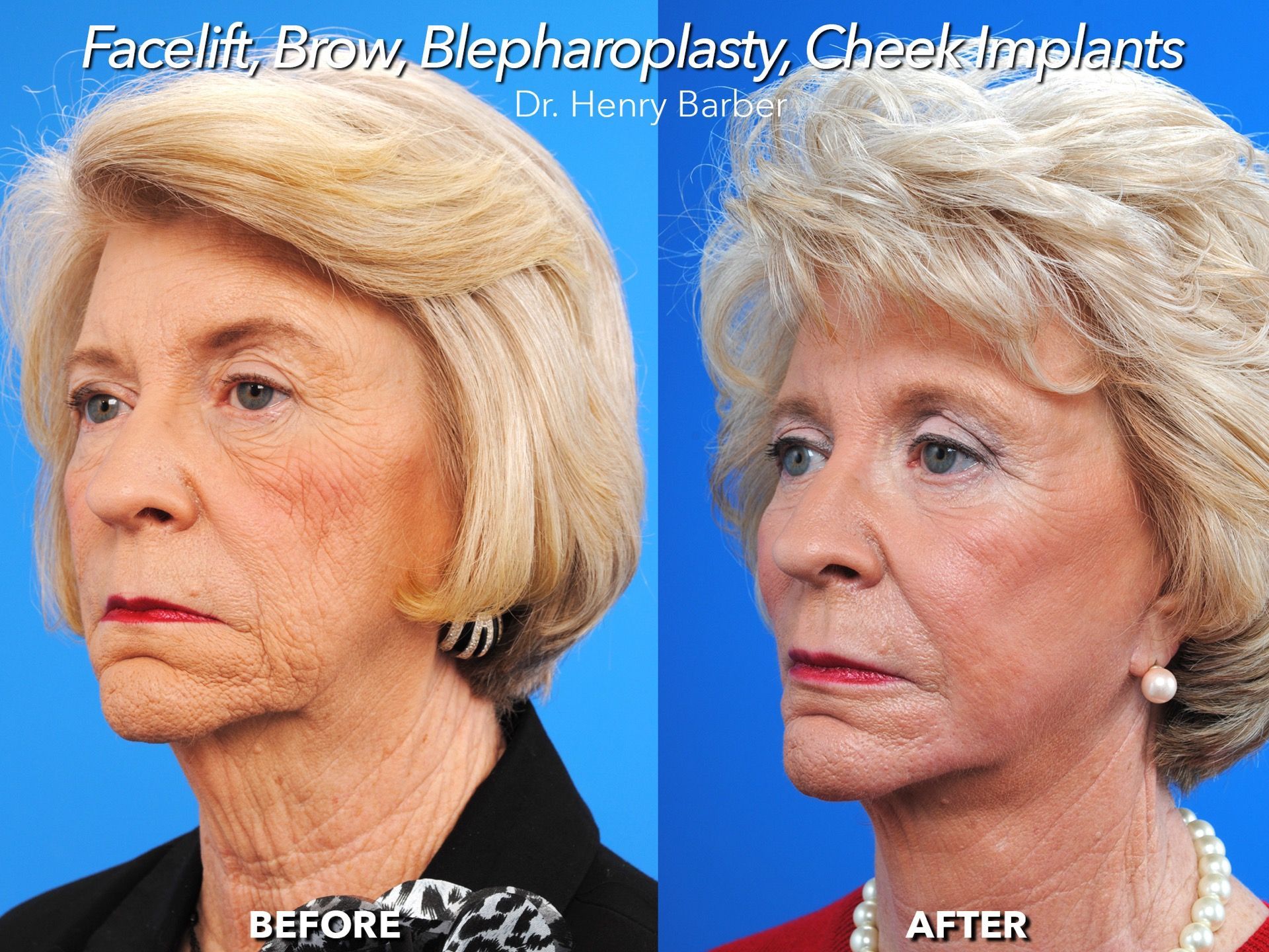 client at barber facial plastic surgery before and after facelift- mobile al henry barber
