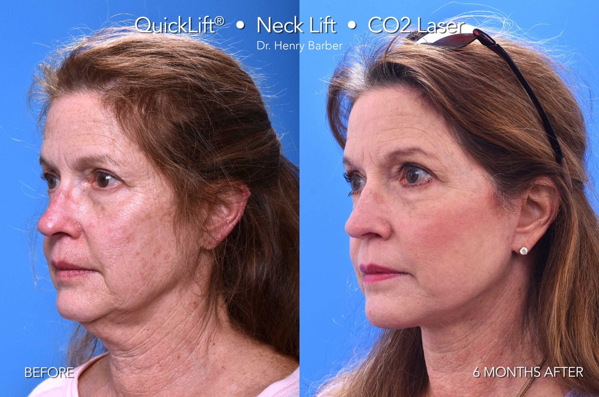 client at barber facial plastic surgery before and after quicklift - mobile al henry barber