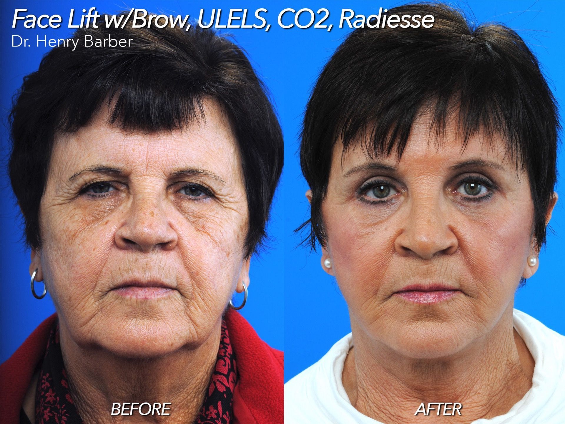 client at barber facial plastic surgery before and after facelift with brow lift - mobile al henry barber