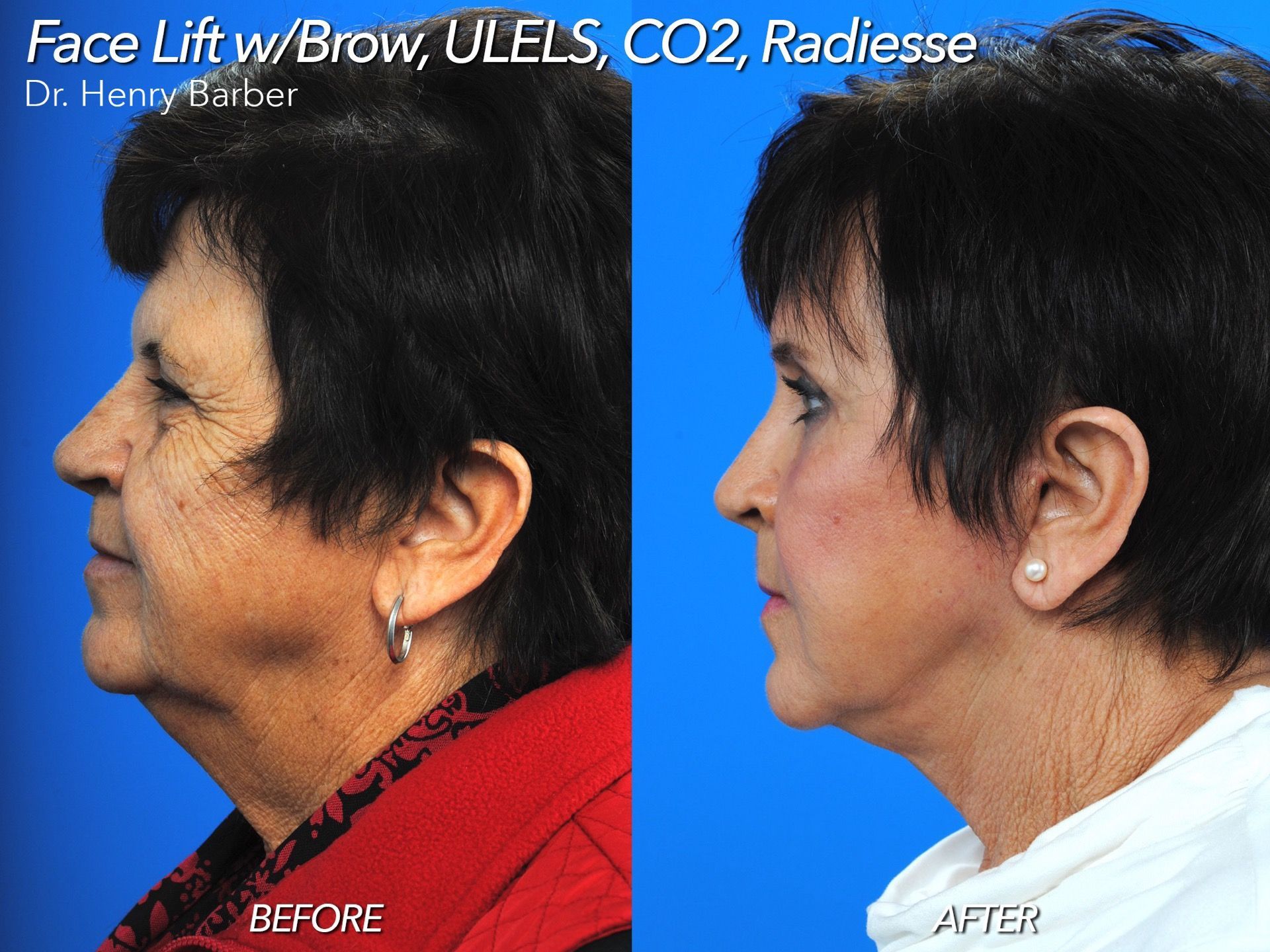 client at barber facial plastic surgery before and after facelift with brow lift - mobile al henry barber