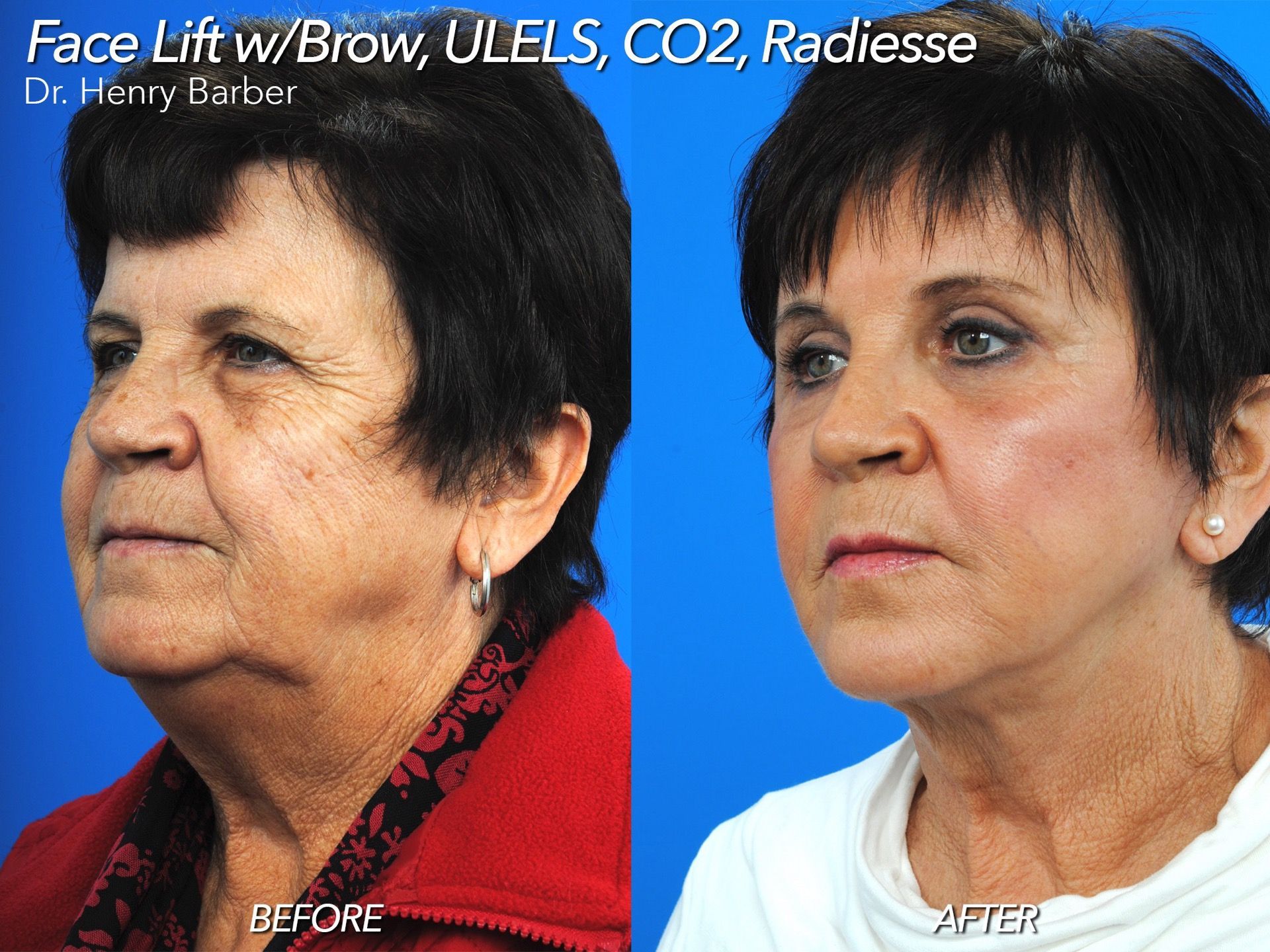 client at barber facial plastic surgery before and after facelift with brow lift - mobile al henry barber