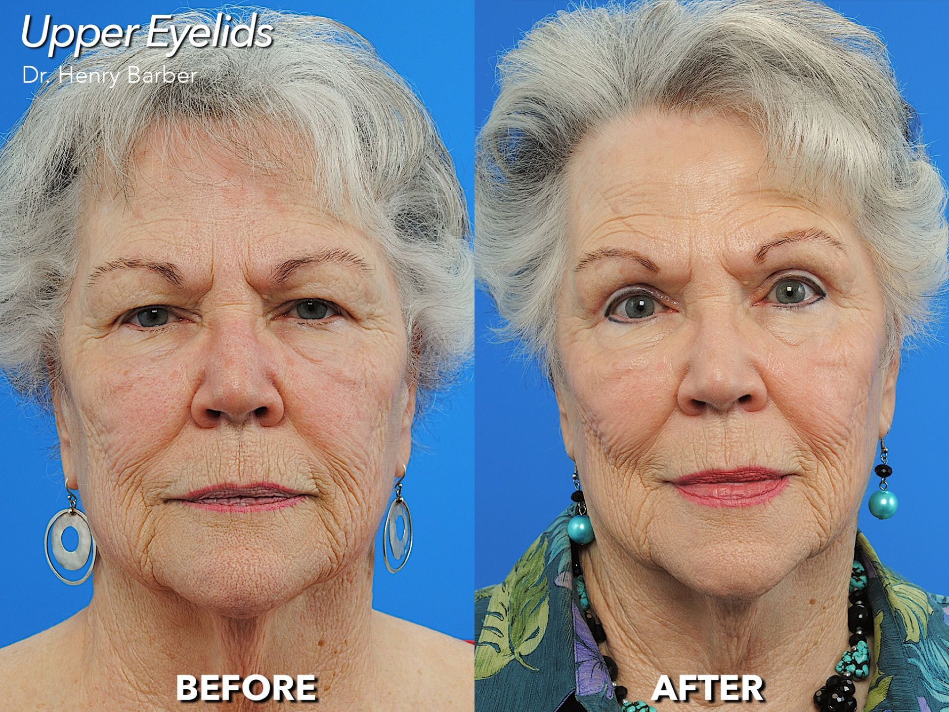 patient at barber facial plastic surgery before and after eyelid surgery