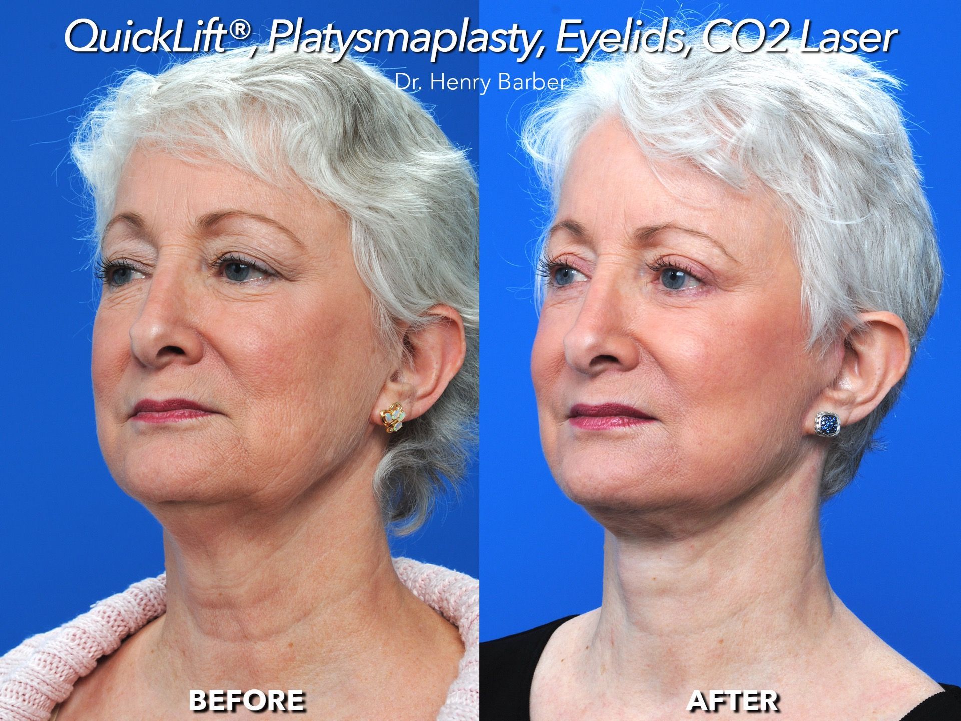 client at barber facial plastic surgery before and after quicklift - mobile al henry barber