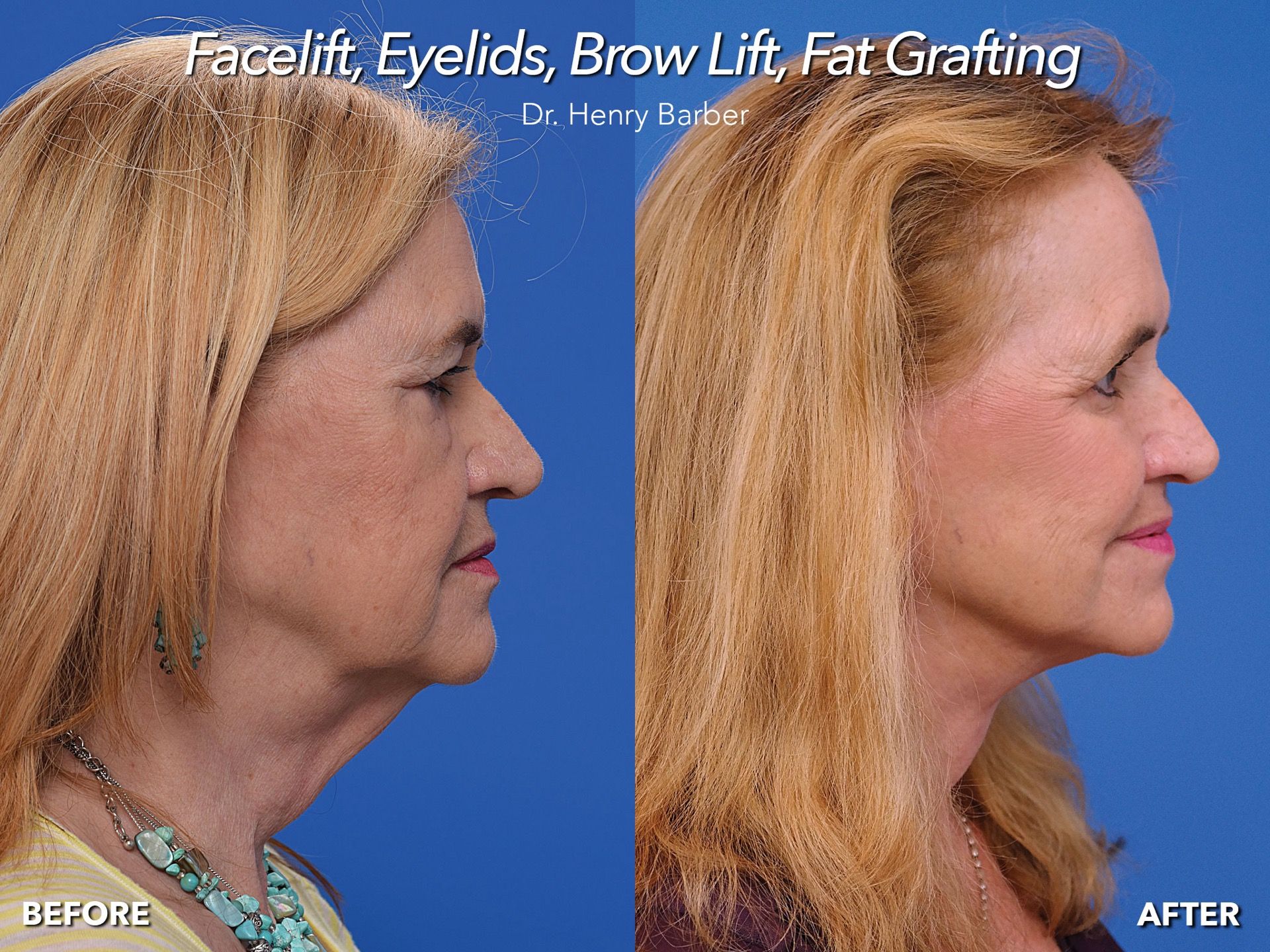 client at barber facial plastic surgery before and after facelift with brow - mobile al henry barber