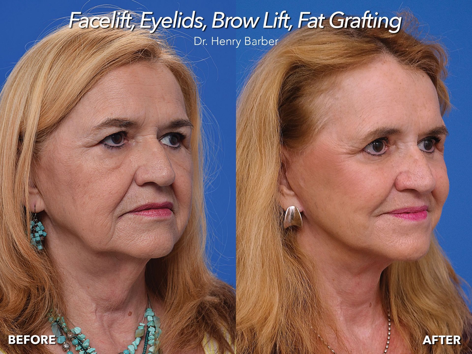 client at barber facial plastic surgery before and after quicklift with brow - mobile al henry barber
