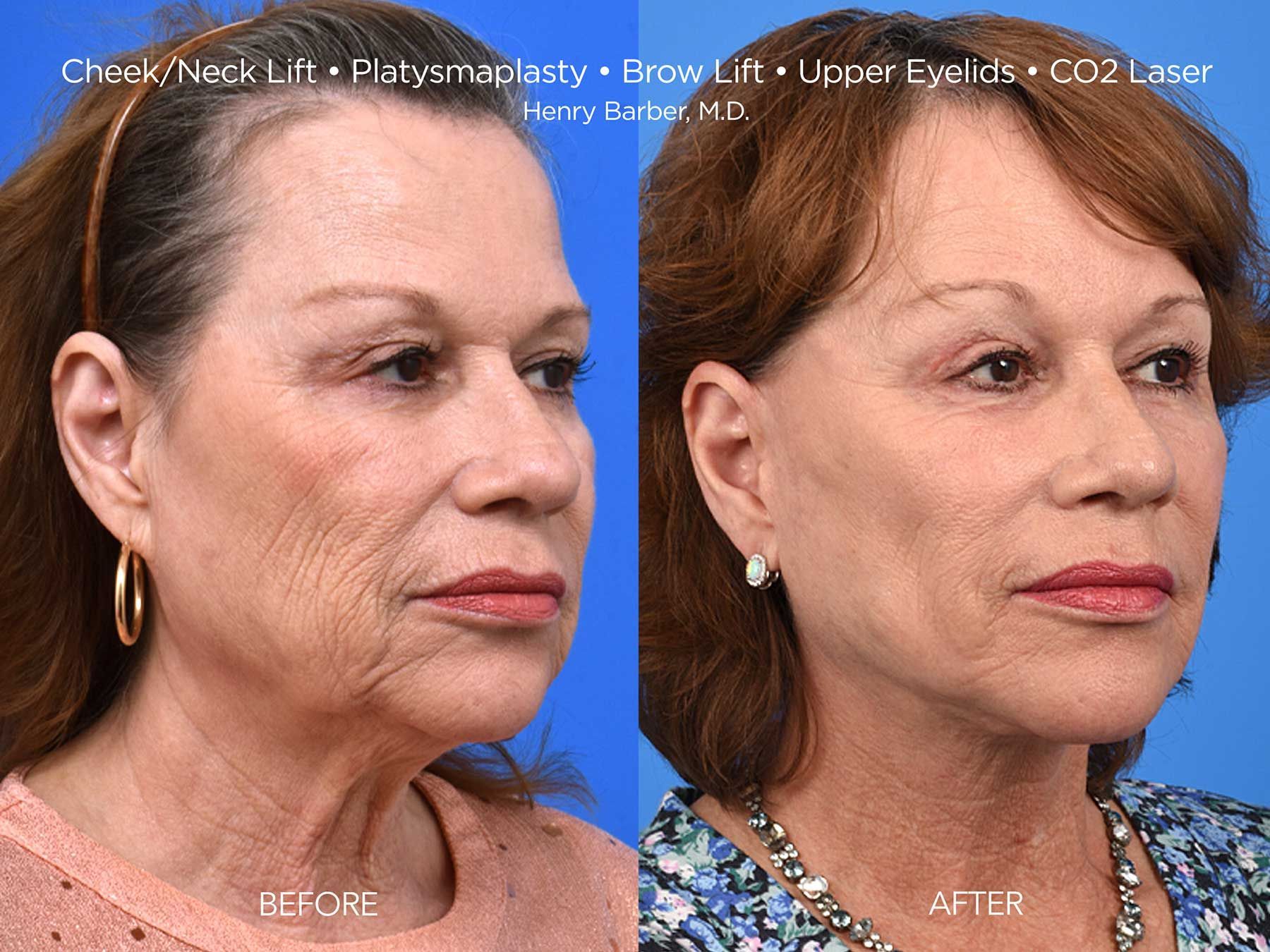 patient at barber facial plastic surgery before and after Neck Lift - mobile fairhope AL