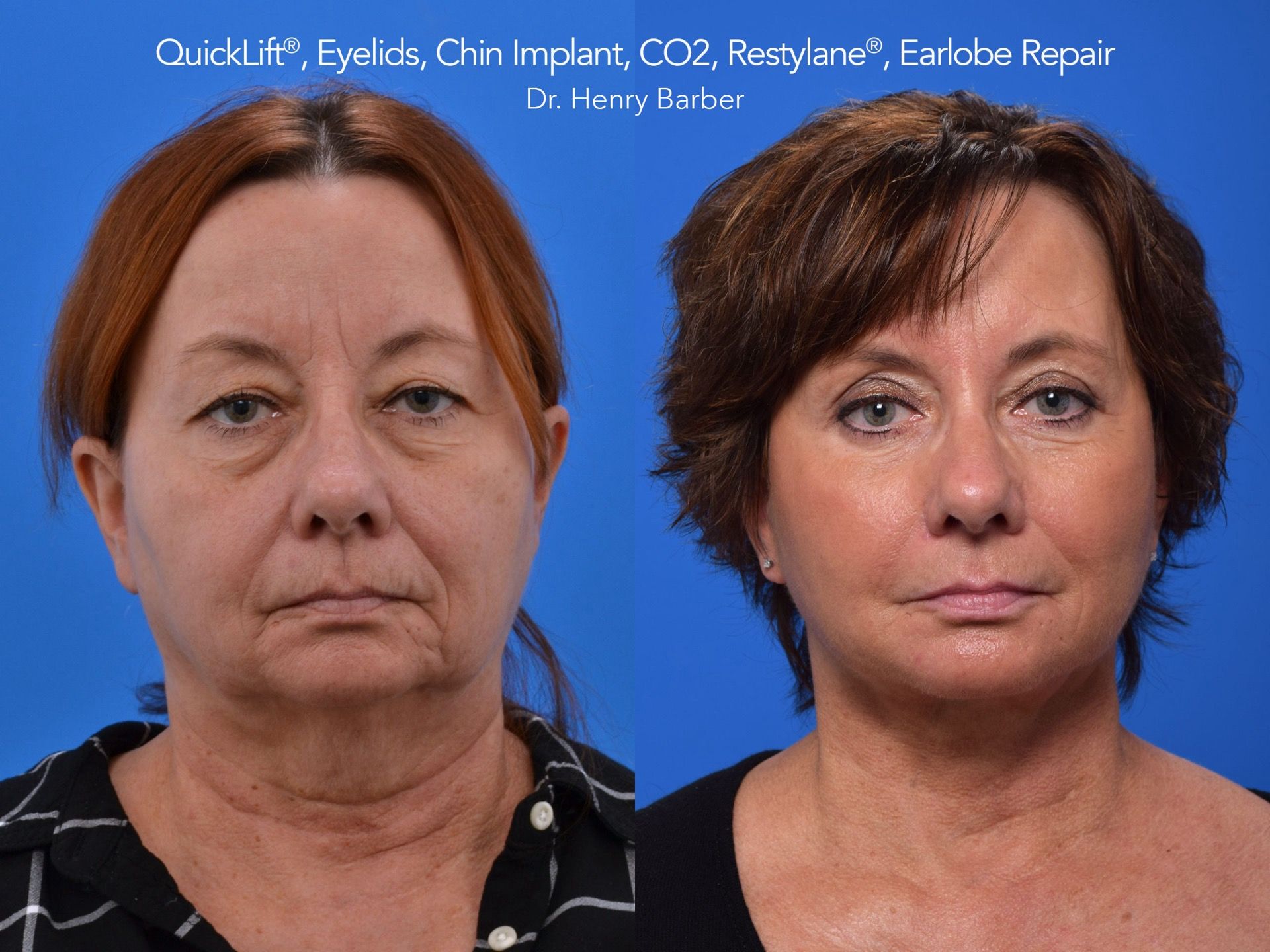 patient at barber facial plastic surgery before and after facial implants - mobile alabama