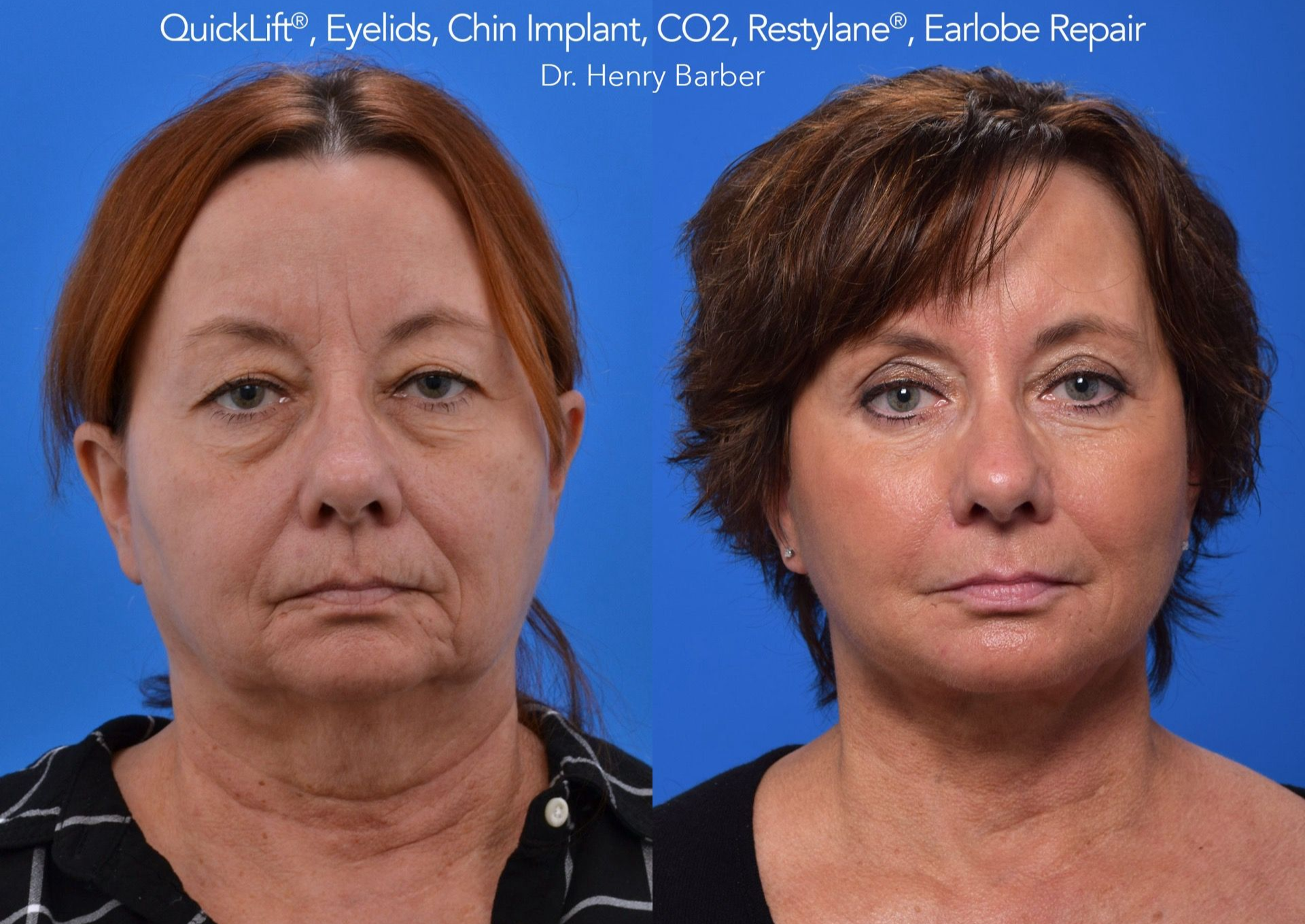 client at barber facial plastic surgery before and after quicklift- mobile al henry barber