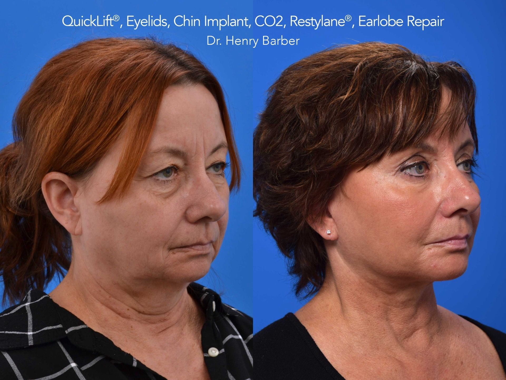 patient at barber facial plastic surgery before and after facial implants - mobile alabama