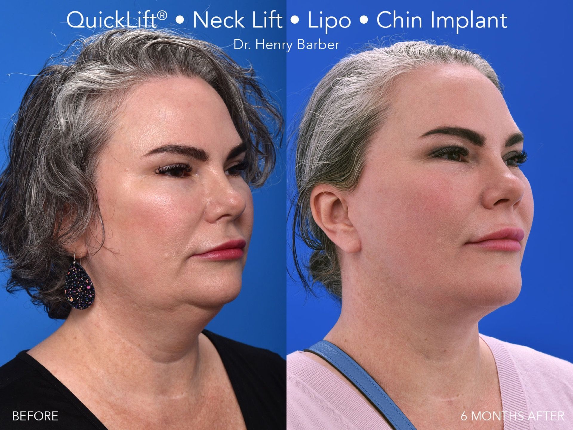 patient at barber facial plastic surgery before and after Neck Lift - mobile fairhope AL
