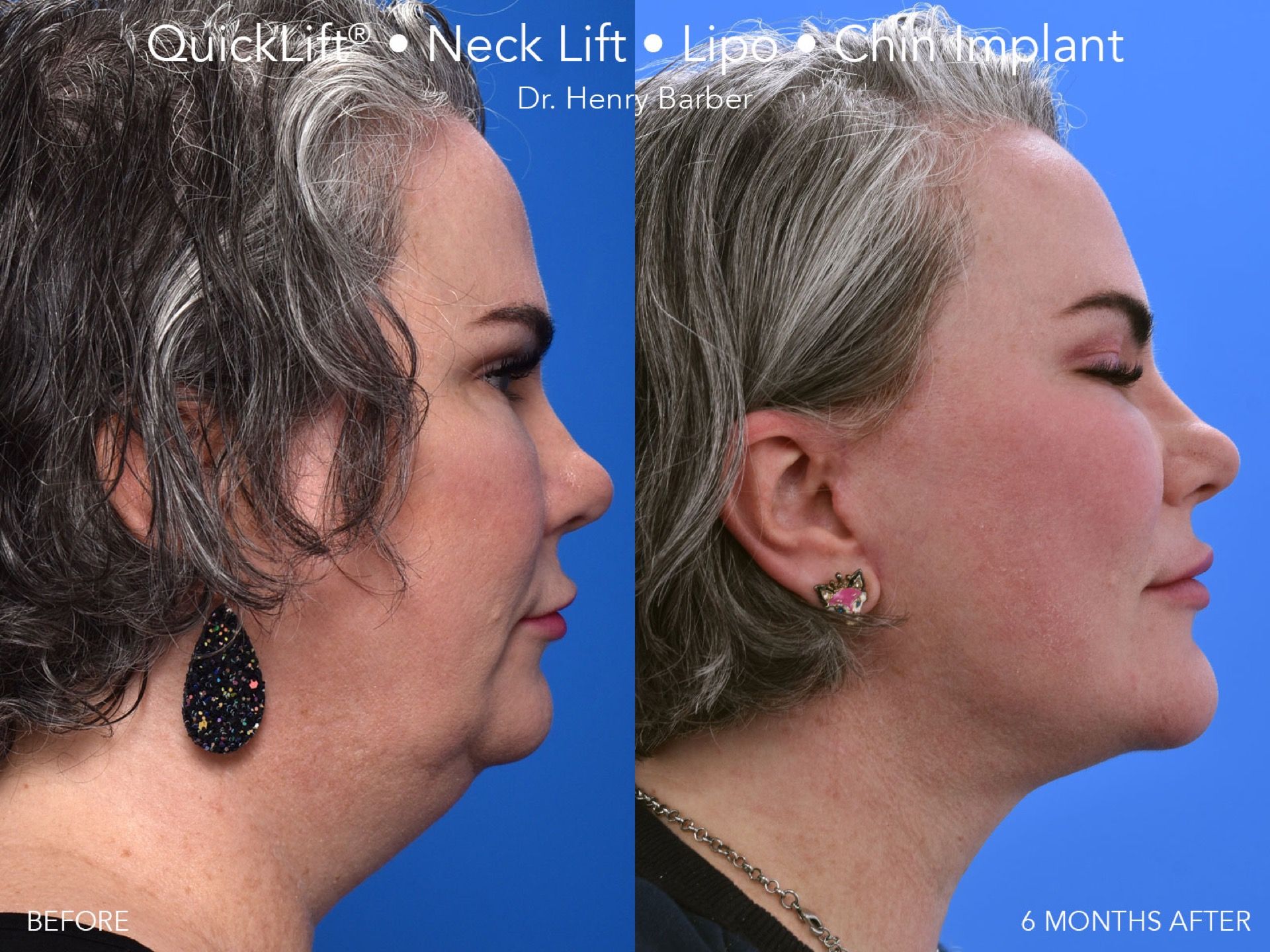client at barber facial plastic surgery before and after quicklift  - mobile al henry barber