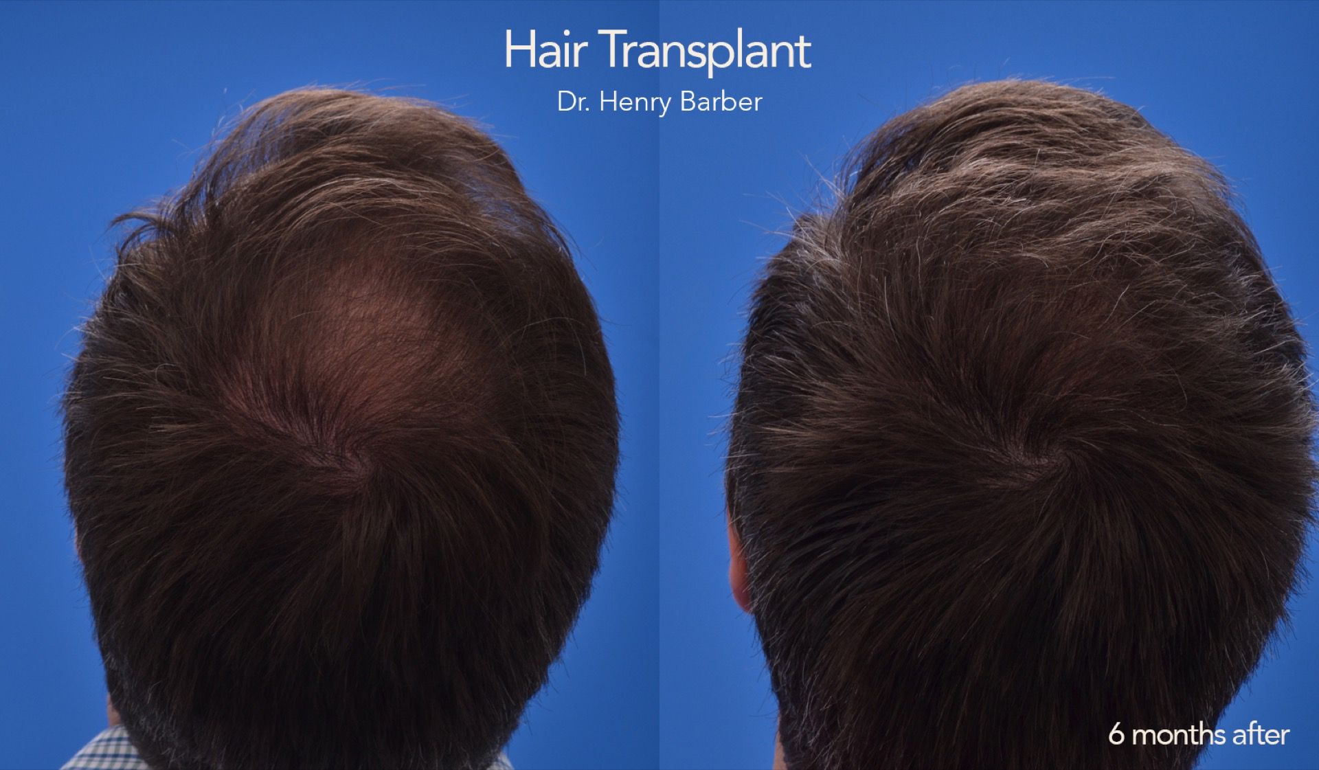 client at barber facial plastic surgery before and after - mobile al henry barber hair transplant 