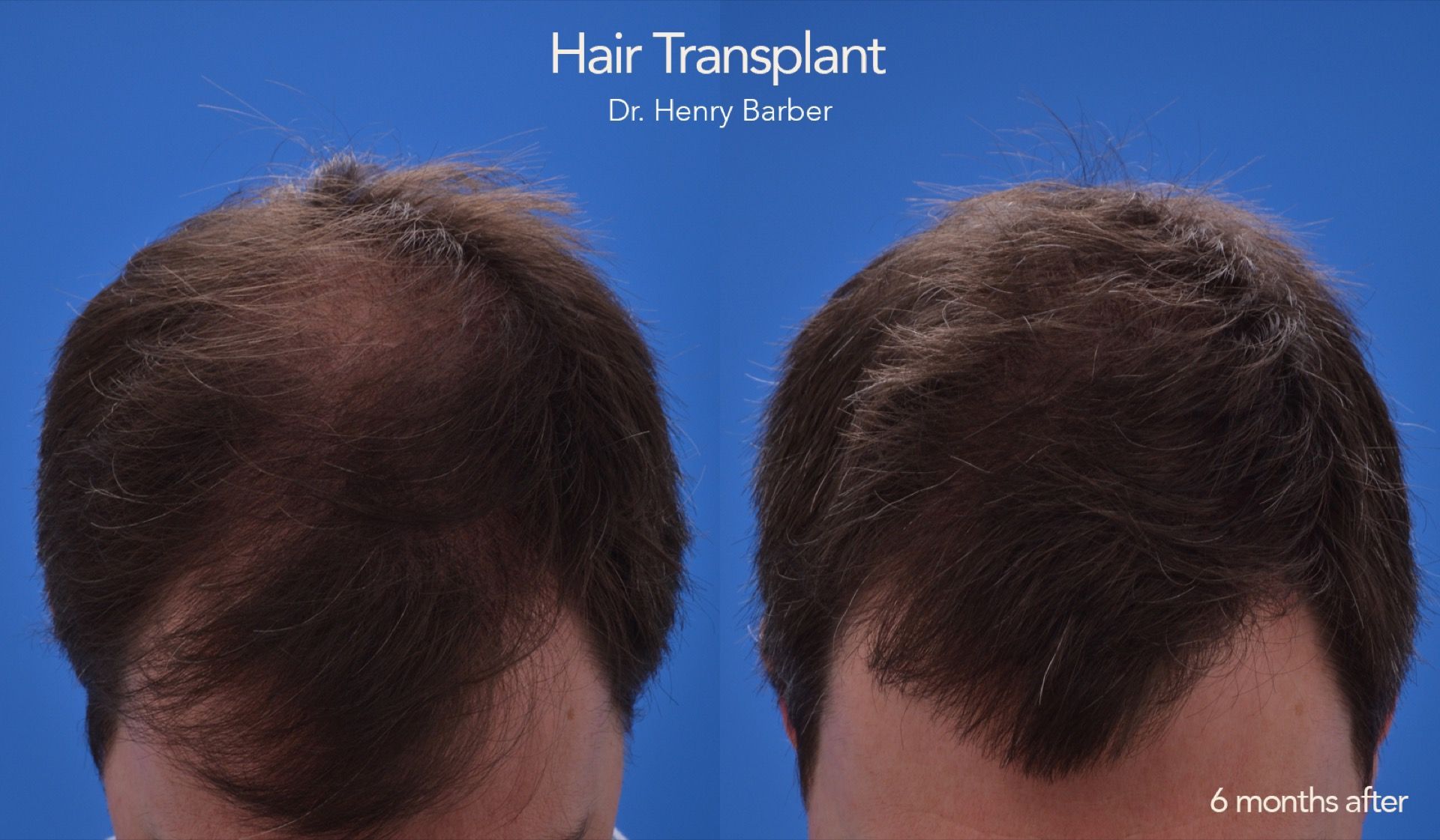 client at barber facial plastic surgery before and after - mobile al henry barber hair transplant 